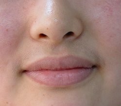 激光脱唇毛对比案例