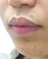 厚唇改薄整形前后对比
