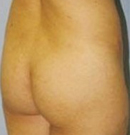臀部水动力环形吸脂翘臀案例
