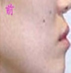 注射丰面颊前后对比照