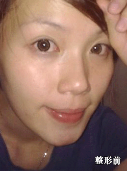 模特陈小姐整形前后