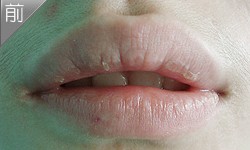 厚唇变薄案例