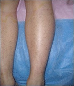 腿部脱毛对比案例