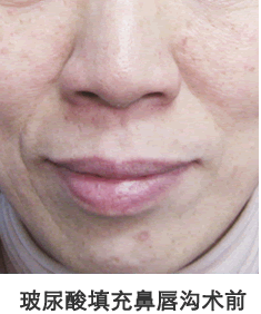玻尿酸填充鼻唇沟前后对比