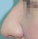 北京清木驼峰鼻矫正前后对比图