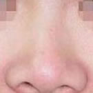 北京清木硅胶隆鼻