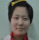 北京清木整形日式桃花眼和隆鼻手术