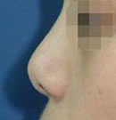 北京清木鹰钩鼻矫正