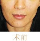 北京清木注射prp自体血清前后