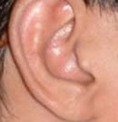 北京清木玻尿酸丰耳垂