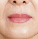 北京清木面部填充前后对比