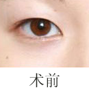 北京清木桃花电眼双眼皮手术前后对比