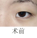 北京清木压双眼皮对比图