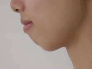 隆下颌手术对比图