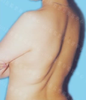 背部吸脂前后对比图