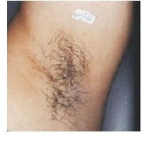 激光脱腋毛前后对比图片