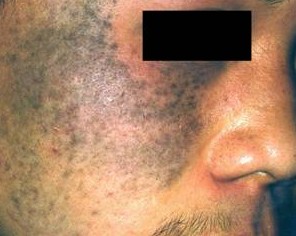 太田痣美容前后对比