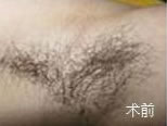 腋毛祛除前后对比图