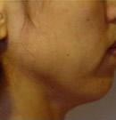 面部颈部提升术前后对比照片