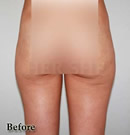 臀部、大腿吸脂术前后对比照片
