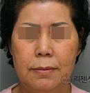 韩式除皱手术案例对比图