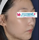 均衡缩鼻术前后对比案例