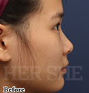 line鼻部整形对比案例