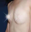 隆胸微整形手术前后对比照片