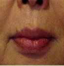口周皱纹祛除术前与术后三年对比照片