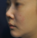 韩国4月31日整形外科短鼻矫正对比照片
