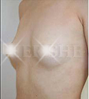 隆胸手术案例对比图