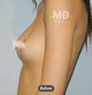 乳房不对称矫正整形手术前后对比案例