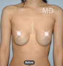 乳房下垂矫正手术前后对比照片