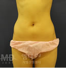 腰腹吸脂整形术前后对比照片