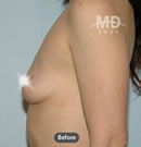 韩国MD整形外科假体隆胸术对比案例