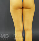 大腿吸脂手术前后对比照片