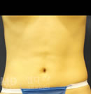 腰部吸脂手术前后对比照片