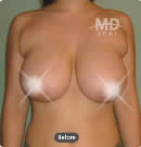胸部整形手术前后案例对比照片