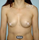 乳房不对称矫正术前后对比照片