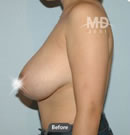 韩国MD整形外科乳房下垂矫正术+乳晕缩小术对比案例