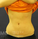 腰部吸脂手术前后对比照片