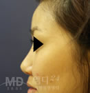 丰额头整形术前后对比照片