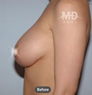 韩国MD整形外科乳房下垂矫正术对比案例