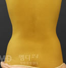 腰部吸脂整形手术前后对比照片
