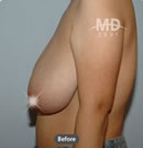 韩国MD整形外科巨乳缩小+乳房下垂矫正对比案例