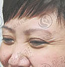 保妥适注射祛除鱼尾纹效果对比图