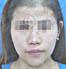 自体脂肪颞部填充效果对比图