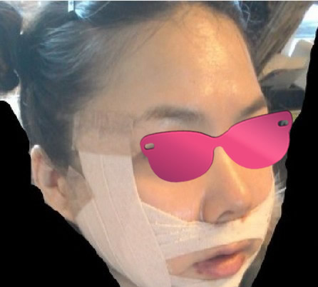 这是出院时拍的照片，感觉到我下巴有变化吗?

实际上我脸上的胶布没有贴的很好，一到家胶布就掉下来了呢!那时候的我刚刚才结束手术，处于非常敏感的状态，因此有点埋怨医院，埋怨院长。较后到药店重新贴上胶布后心情才得到平复。
