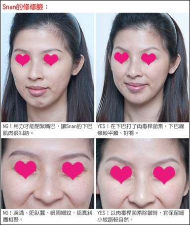 术后的Snan表情还是好自然的，我由衷为她高兴！！~