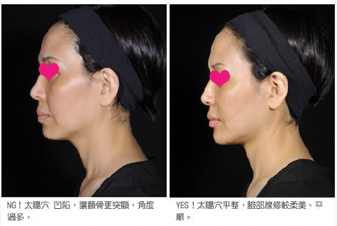 苹果机填充起来了，脸颊有丰润的感觉了！